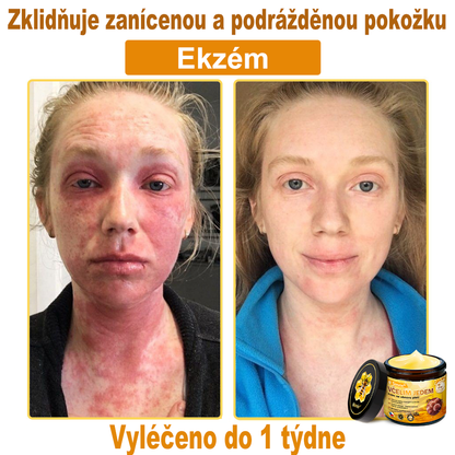💛💛 Sinvie® Krém na obnovu pleti s včelím jedem ✅CE schváleno 👨‍⚕ Doporučeno dermatology - 50ml